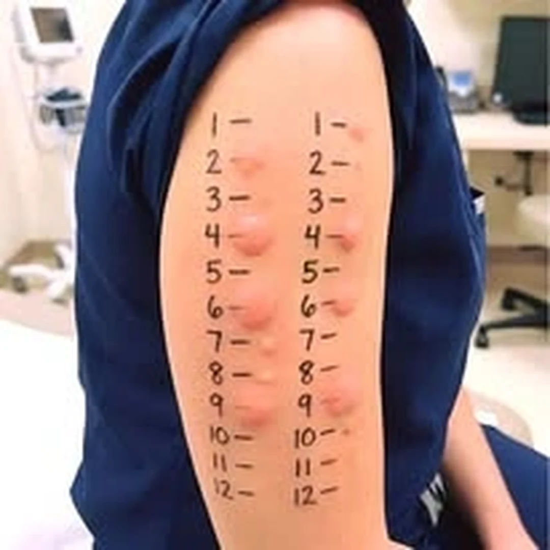 Brazo con dos columnas de números y puntos marcados para una evaluación cutánea de alergias.